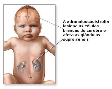 adrenoleucodistrofia