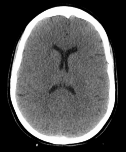 Figura 1 – Imagem obtida por tomografia computadorizada de um cérebro em situação de anoxia. O corpo foi pendurado, tendo o sangue deixado de chegar ao cérebro.