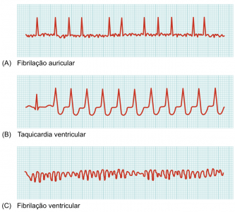 Figura 1 - Traçados característicos das diferentes arritmias referidas neste artigo, obtidos por ECG. (A) fibrilação auricular; (B) taquicardia ventricular; (C) fibrilação ventricular.